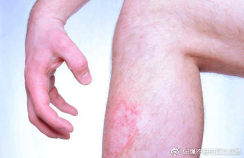 全面选购荨麻疹治疗产品指南